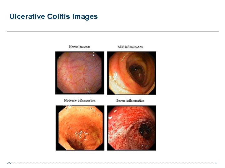 Ulcerative Colitis Images 11 