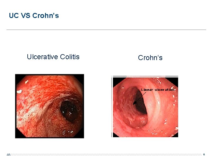 UC VS Crohn’s Ulcerative Colitis Crohn’s 12 