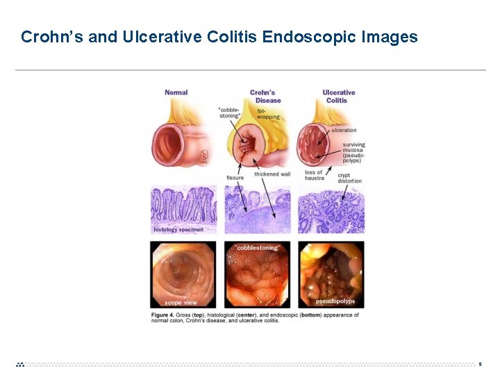 Crohn’s and Ulcerative Colitis Endoscopic Images 9 