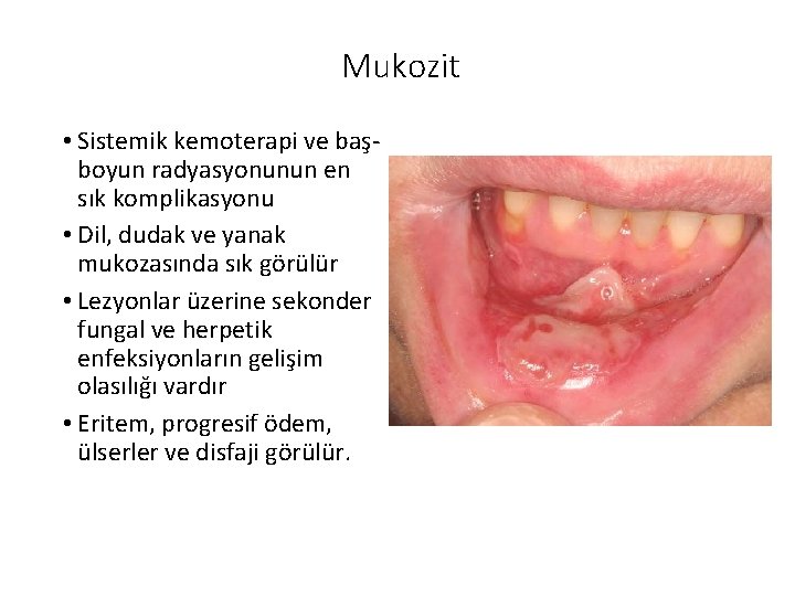 Mukozit • Sistemik kemoterapi ve başboyun radyasyonunun en sık komplikasyonu • Dil, dudak ve