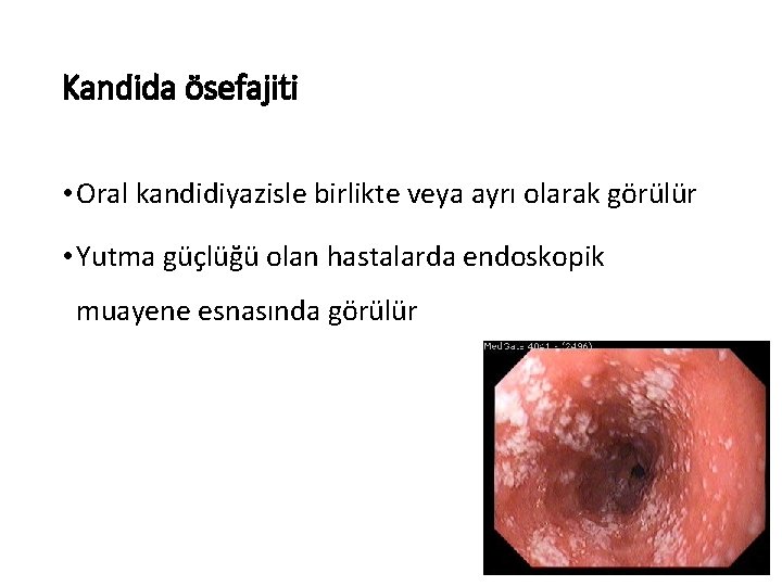 Kandida ösefajiti • Oral kandidiyazisle birlikte veya ayrı olarak görülür • Yutma güçlüğü olan