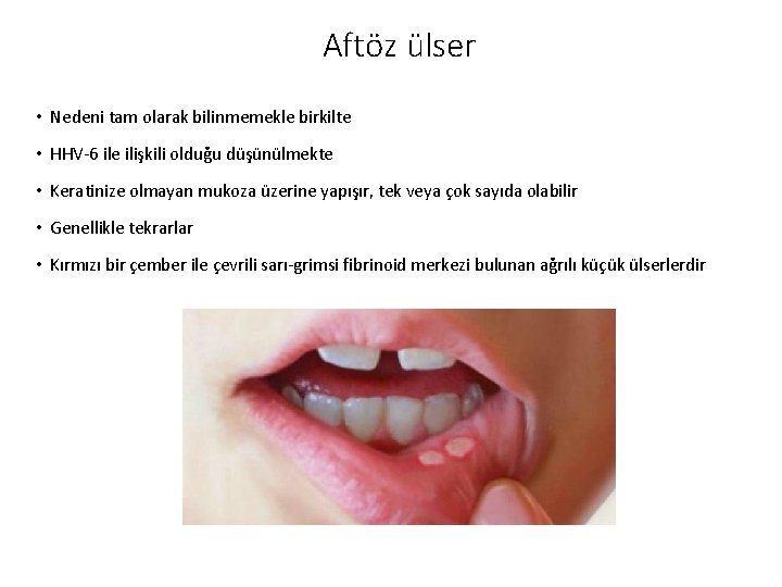 Aftöz ülser • Nedeni tam olarak bilinmemekle birkilte • HHV-6 ile ilişkili olduğu düşünülmekte