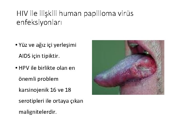 HIV ile ilişkili human papilloma virüs enfeksiyonları • Yüz ve ağız içi yerleşimi AIDS