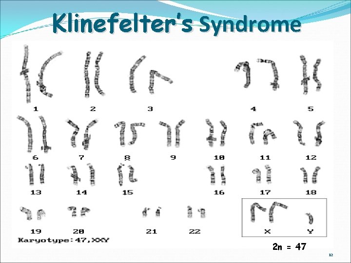 Klinefelter’s Syndrome 2 n = 47 12 
