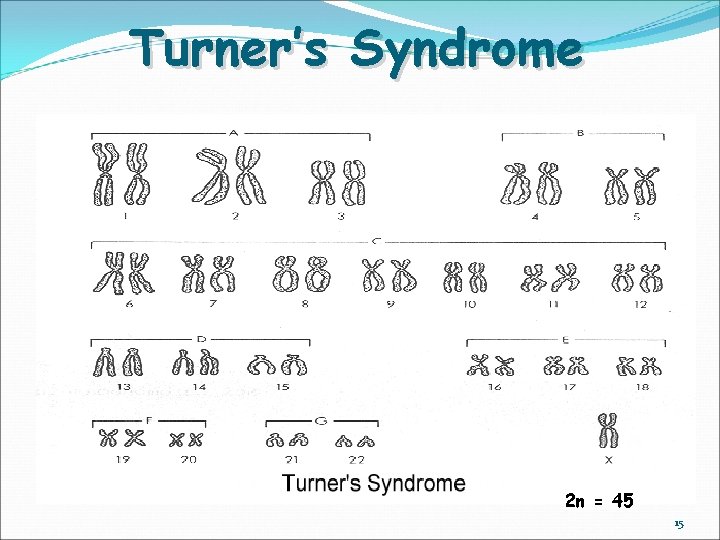 Turner’s Syndrome 2 n = 45 15 