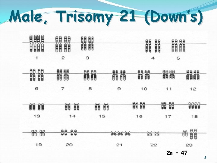 Male, Trisomy 21 (Down’s) 2 n = 47 8 