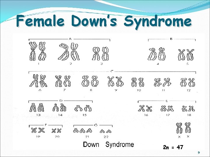 Female Down’s Syndrome 2 n = 47 9 