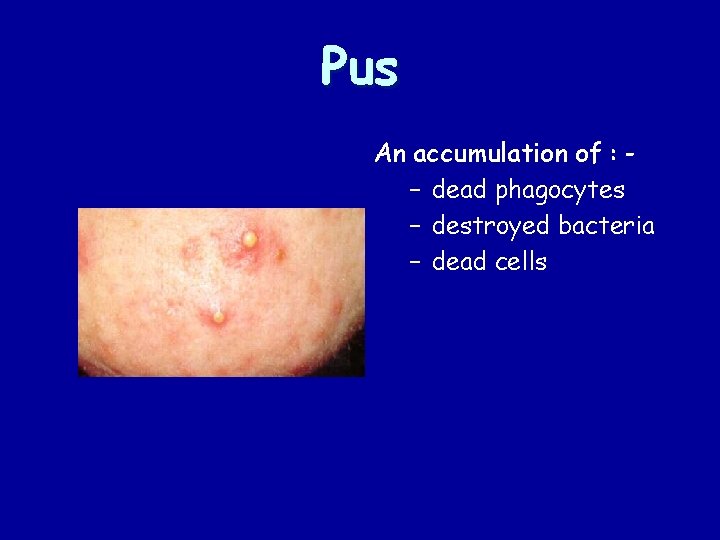 Pus An accumulation of : – dead phagocytes – destroyed bacteria – dead cells