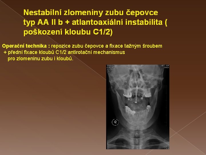 Nestabilní zlomeniny zubu čepovce typ AA II b + atlantoaxiální instabilita ( poškození kloubu