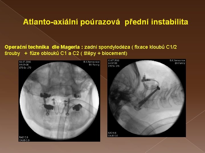 Atlanto-axiální poúrazová přední instabilita Operační technika dle Magerla : zadní spondylodéza ( fixace kloubů