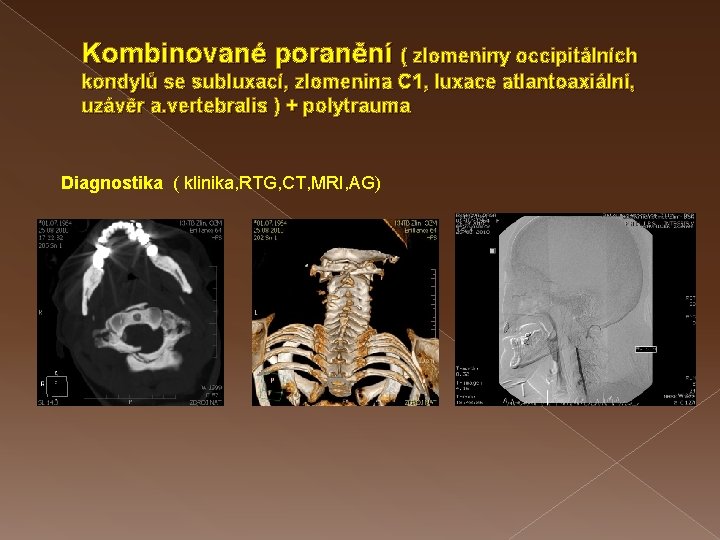 Kombinované poranění ( zlomeniny occipitálních kondylů se subluxací, zlomenina C 1, luxace atlantoaxiální, uzávěr