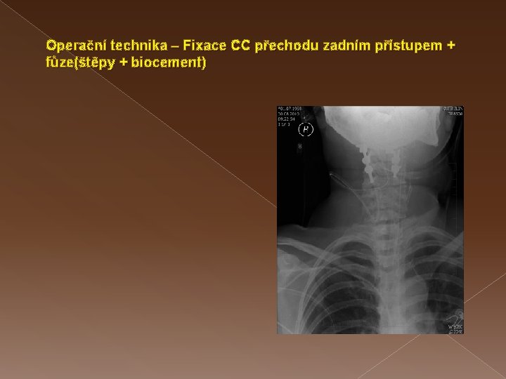 Operační technika – Fixace CC přechodu zadním přístupem + fůze(štěpy + biocement) 