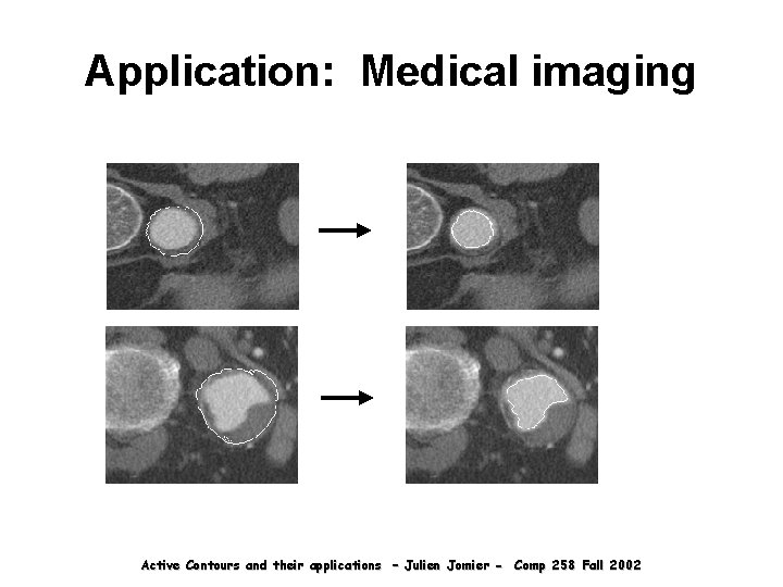 Application: Medical imaging Active Contours and their applications – Julien Jomier - Comp 258