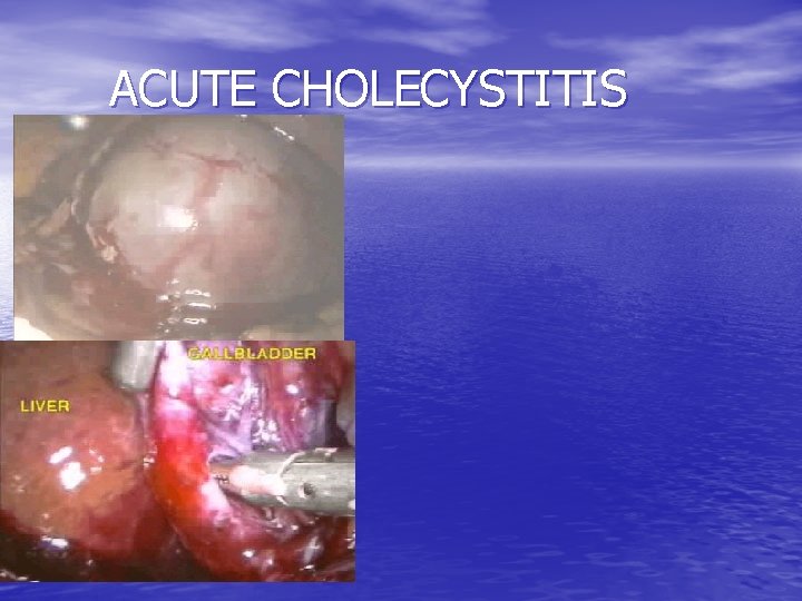 ACUTE CHOLECYSTITIS 