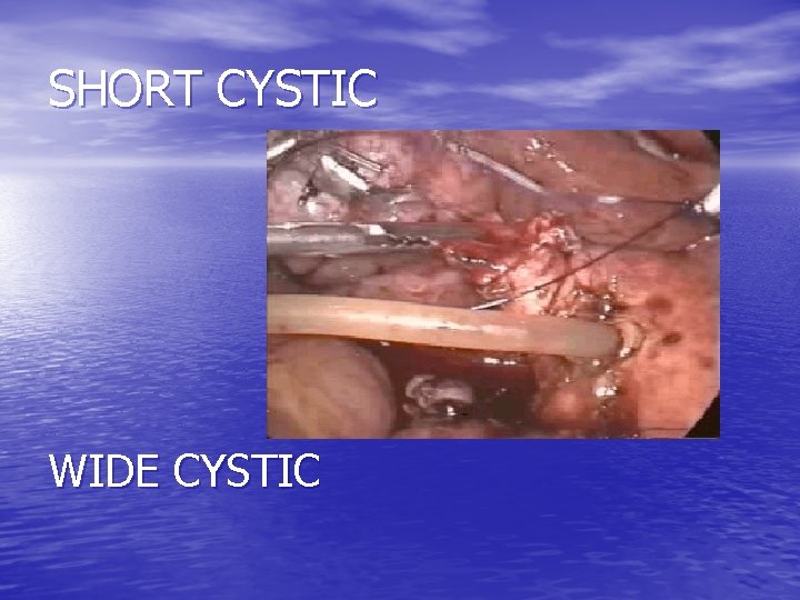 SHORT CYSTIC WIDE CYSTIC 
