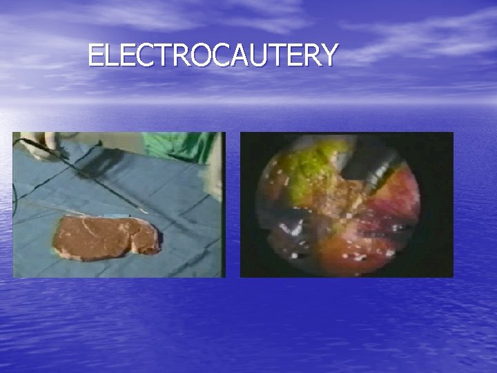 ELECTROCAUTERY 