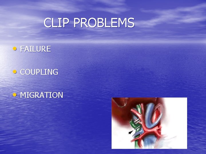 CLIP PROBLEMS • FAILURE • COUPLING • MIGRATION 