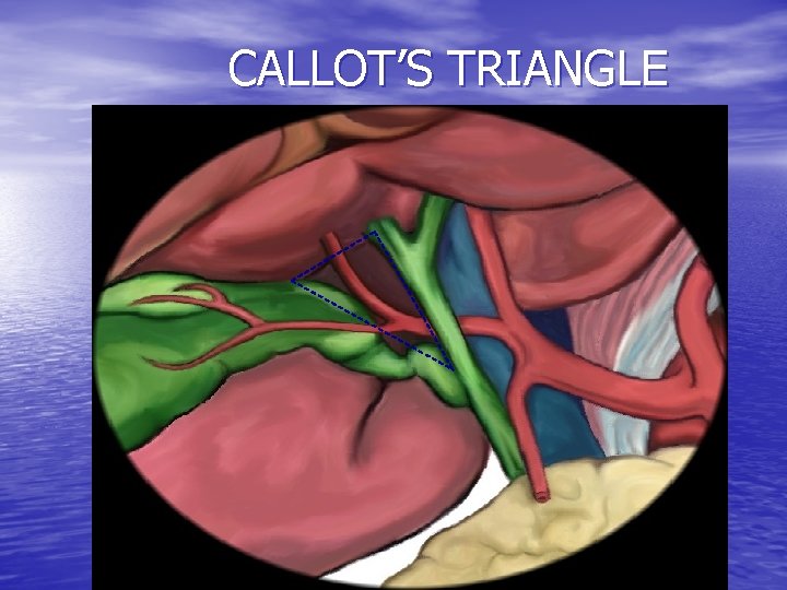 CALLOT’S TRIANGLE 