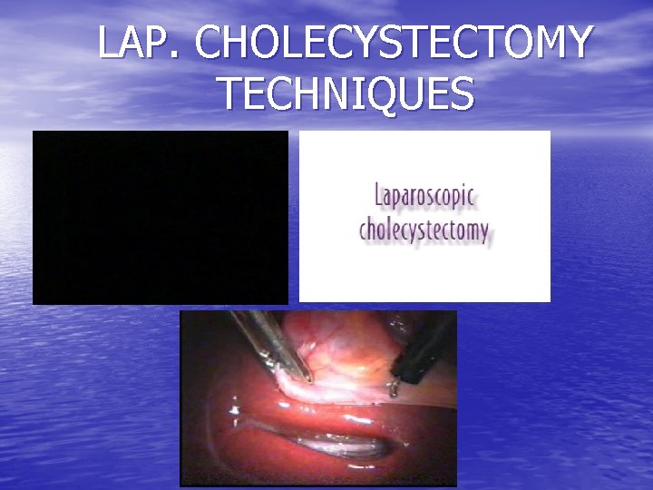 LAP. CHOLECYSTECTOMY TECHNIQUES 