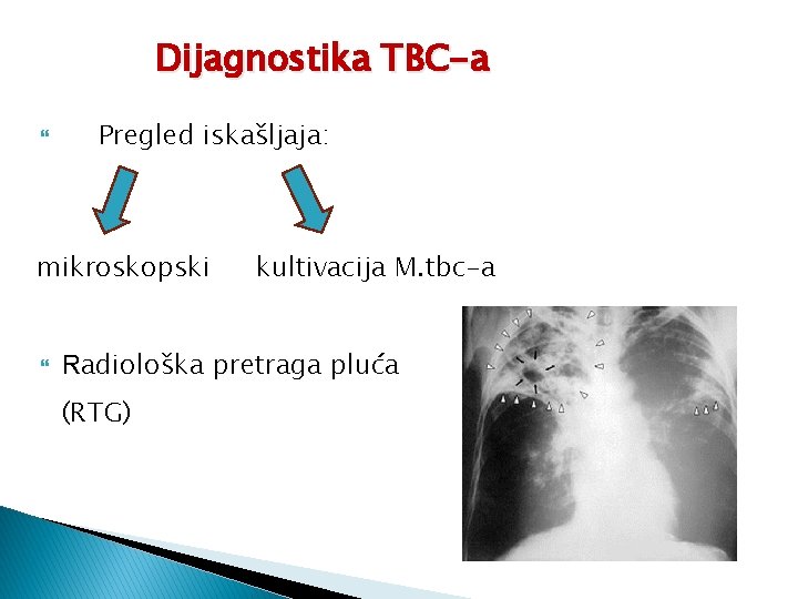 Dijagnostika TBC-a Pregled iskašljaja: mikroskopski kultivacija M. tbc-a Radiološka pretraga pluća (RTG) 