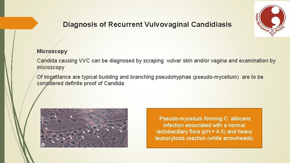 Diagnosis of Recurrent Vulvovaginal Candidiasis Microscopy Candida causing VVC can be diagnosed by scraping