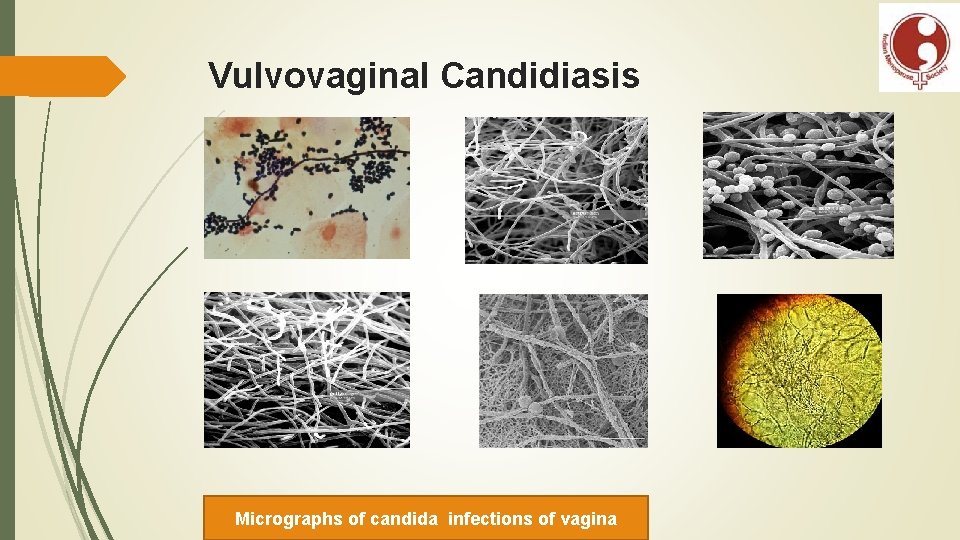 Vulvovaginal Candidiasis Micrographs of candida infections of vagina 