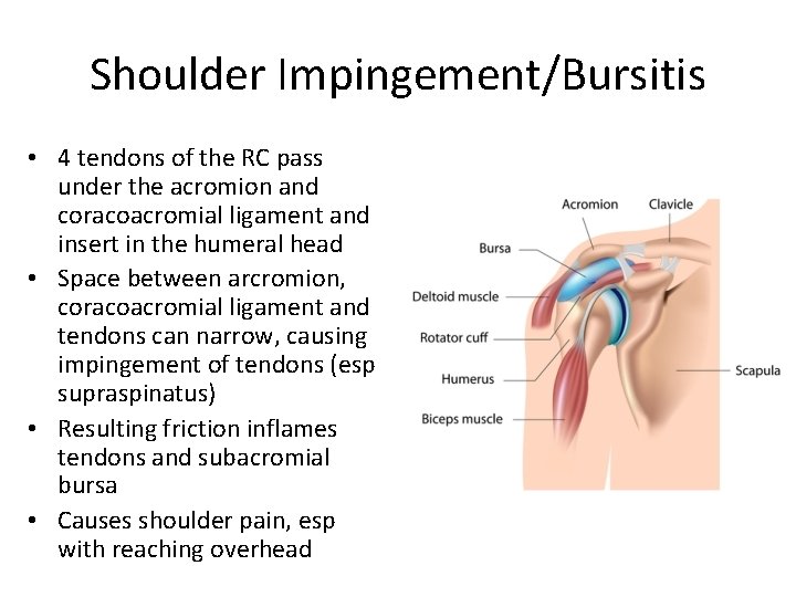 Shoulder Impingement/Bursitis • 4 tendons of the RC pass under the acromion and coracoacromial