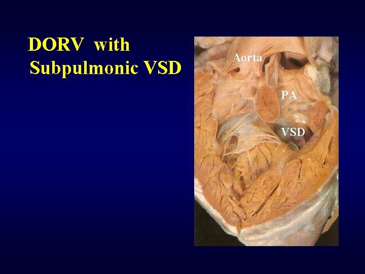 DORV with Subpulmonic VSD Aorta PA VSD 