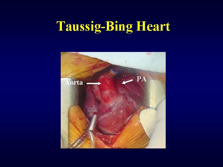 Taussig-Bing Heart Aorta PA 