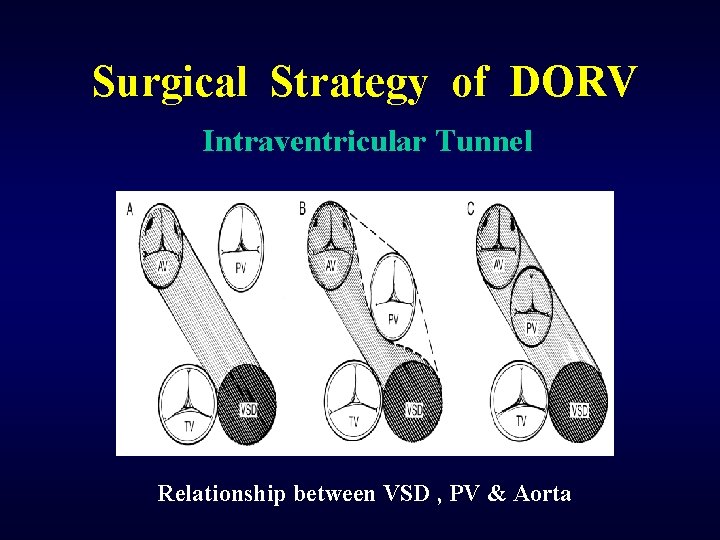 Surgical Strategy of DORV Intraventricular Tunnel Relationship between VSD , PV & Aorta 
