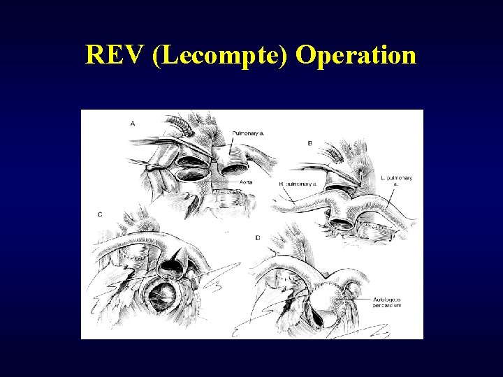 REV (Lecompte) Operation 