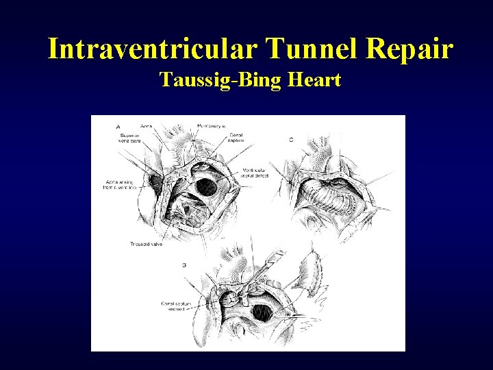 Intraventricular Tunnel Repair Taussig-Bing Heart 