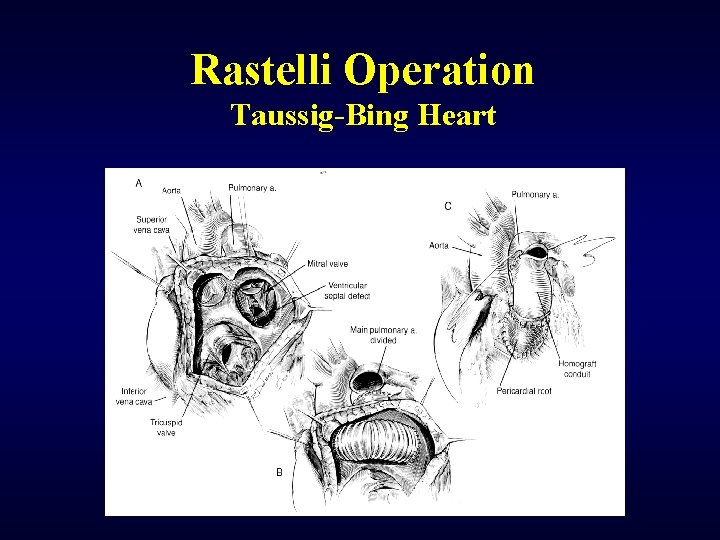 Rastelli Operation Taussig-Bing Heart 