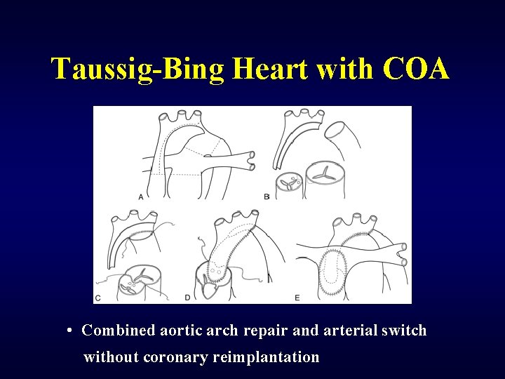 Taussig-Bing Heart with COA • Combined aortic arch repair and arterial switch without coronary