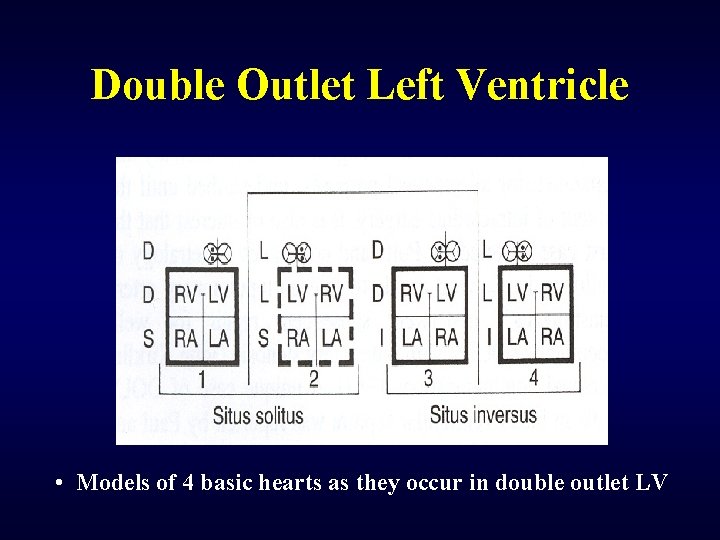 Double Outlet Left Ventricle • Models of 4 basic hearts as they occur in