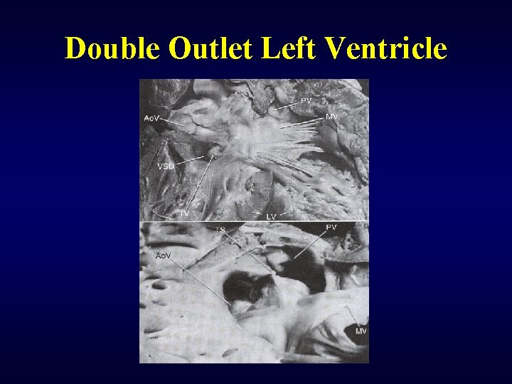 Double Outlet Left Ventricle 