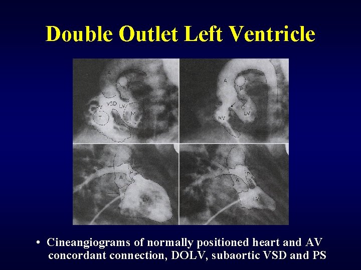 Double Outlet Left Ventricle • Cineangiograms of normally positioned heart and AV concordant connection,