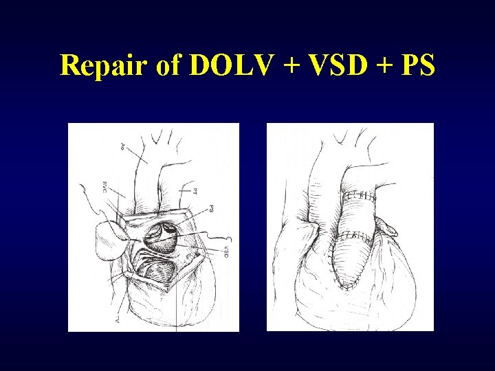 Repair of DOLV + VSD + PS 