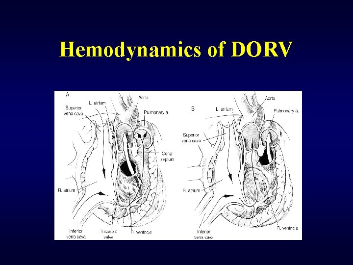 Hemodynamics of DORV 