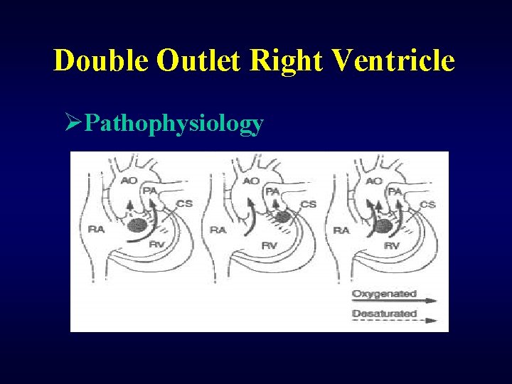 Double Outlet Right Ventricle ØPathophysiology 