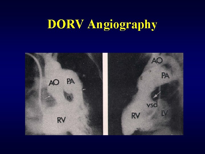 DORV Angiography 