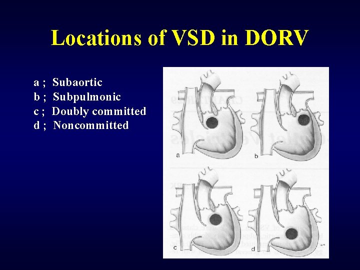 Locations of VSD in DORV a; b; c; d; Subaortic Subpulmonic Doubly committed Noncommitted