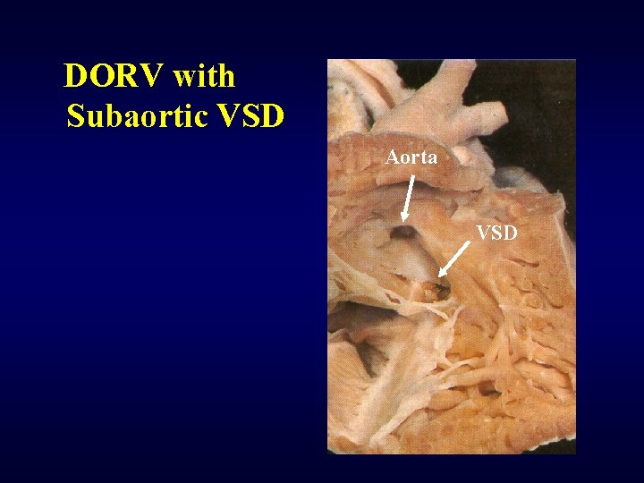 DORV with Subaortic VSD Aorta VSD 