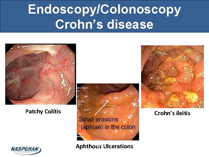 Endoscopy/Colonoscopy Crohn’s disease Patchy Colitis Crohn’s ileitis Aphthous Ulcerations 