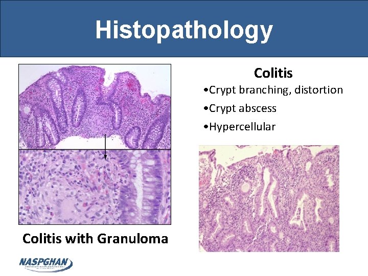 Histopathology Colitis • Crypt branching, distortion • Crypt abscess • Hypercellular Colitis with Granuloma