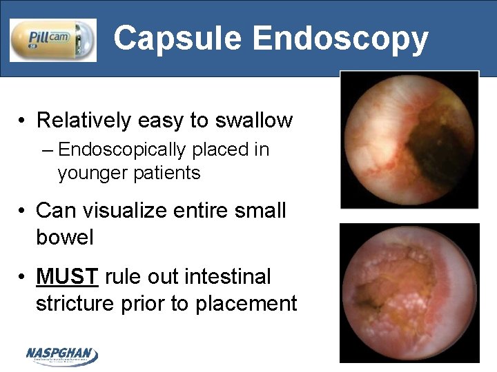 Capsule Endoscopy • Relatively easy to swallow – Endoscopically placed in younger patients •