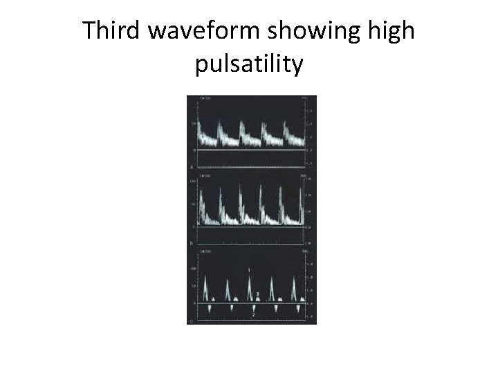 Third waveform showing high pulsatility 