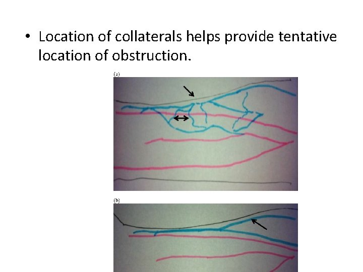  • Location of collaterals helps provide tentative location of obstruction. 