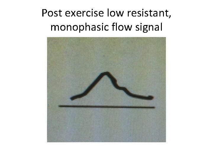 Post exercise low resistant, monophasic flow signal 