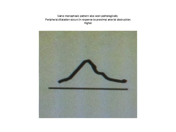 Same monophasic pattern also seen pathologically. Peripheral dilatation occurs in response to proximal arterial